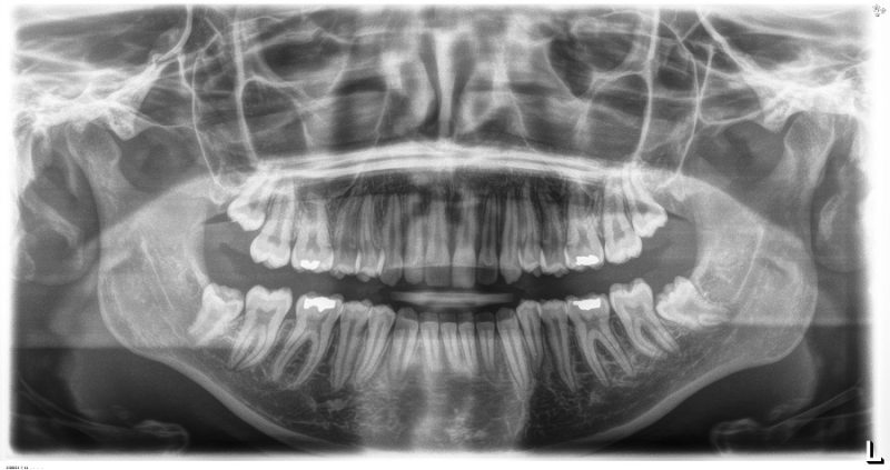 A black and white digital panoramic X-ray (orthopantomogram) showing a full view of a patient's upper and lower teeth, jawbone, and joints.