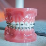 A close-up of a pink anatomical dental model of human teeth showing a full set of silver metal braces.
