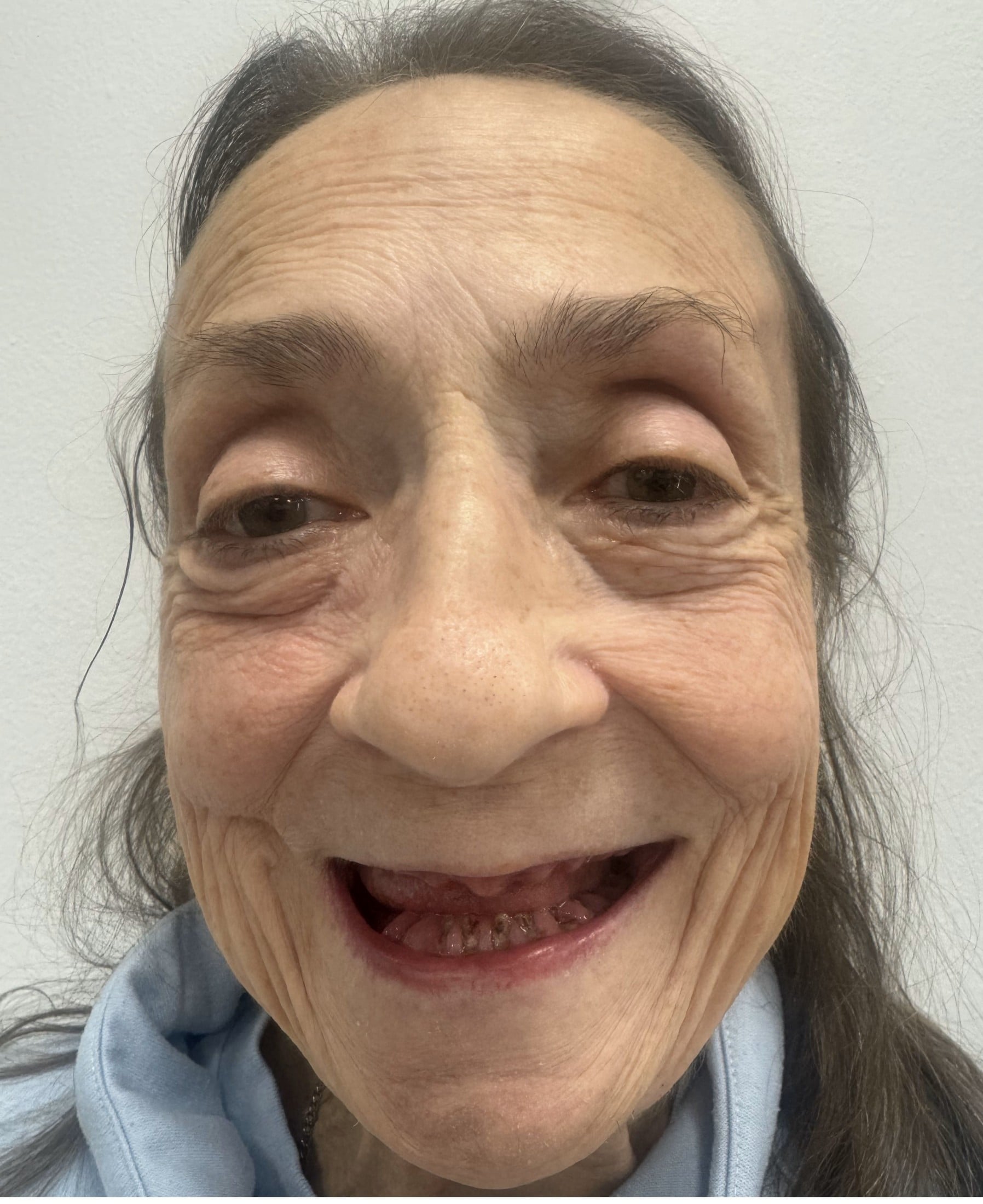 before dental implants