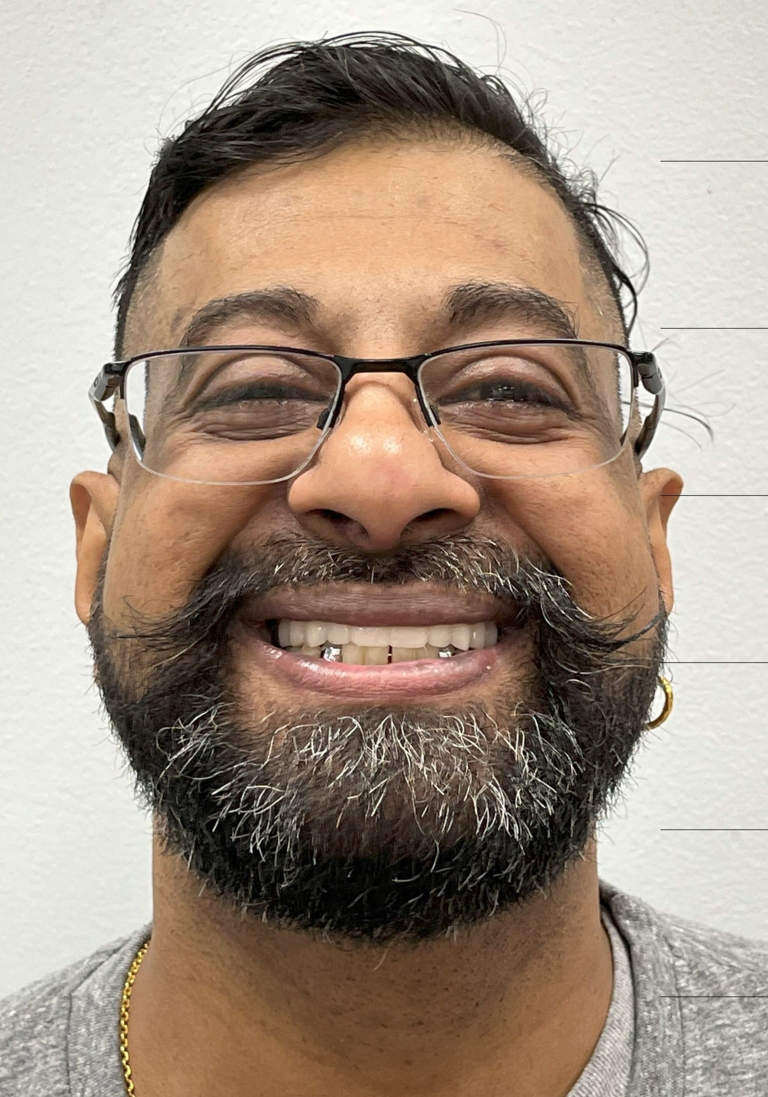 after dental implants