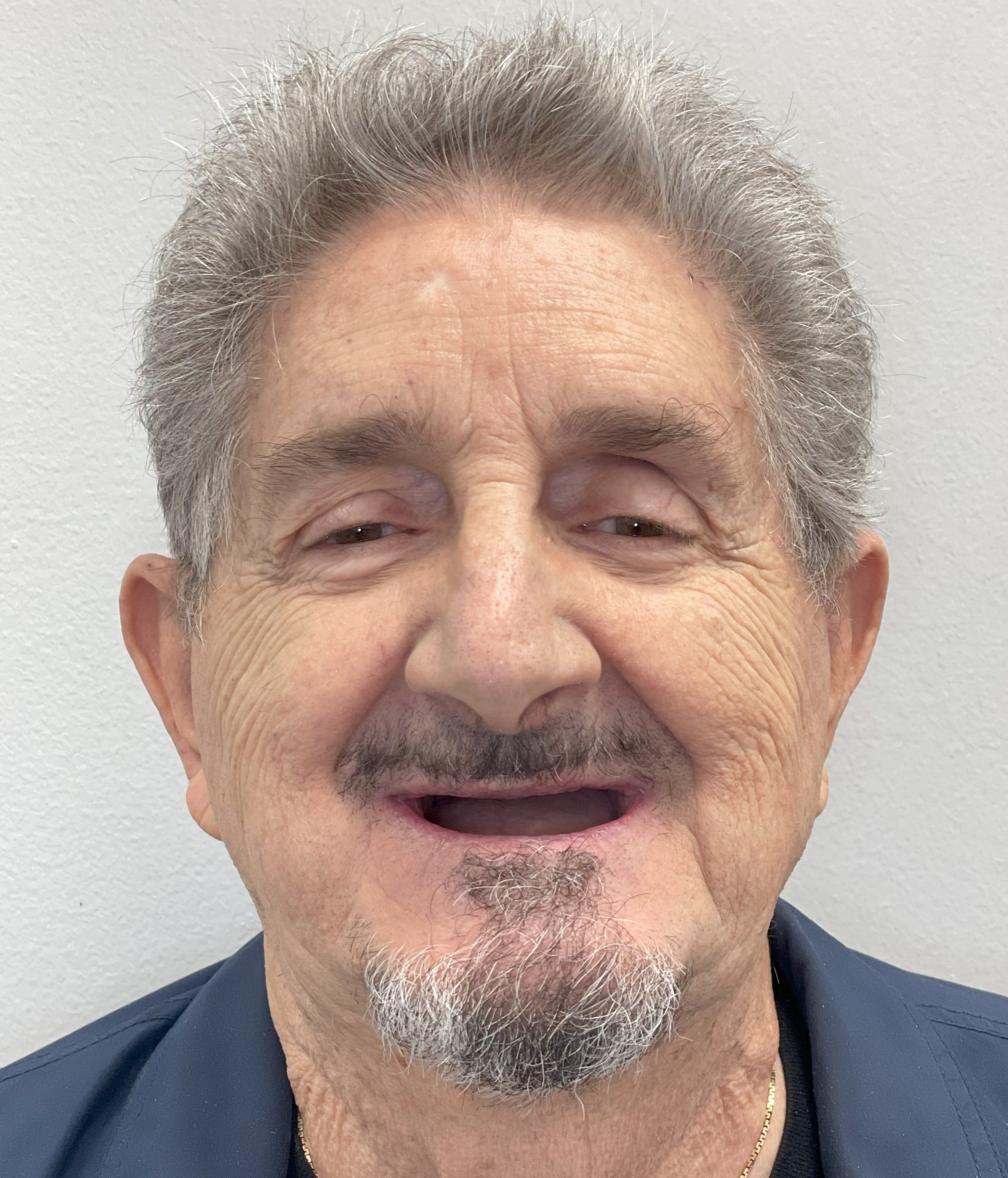 before dental implants