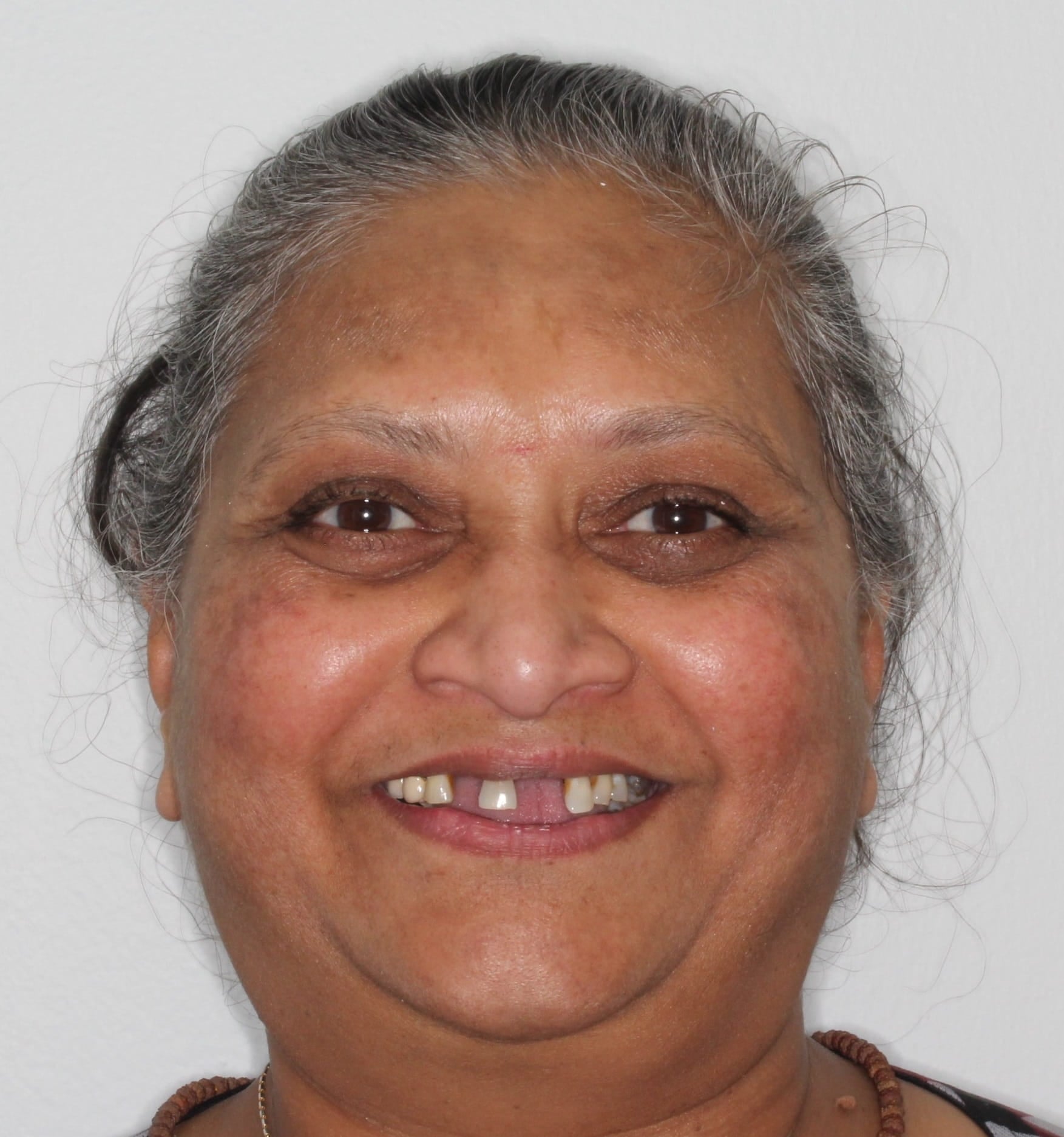 before dental implants