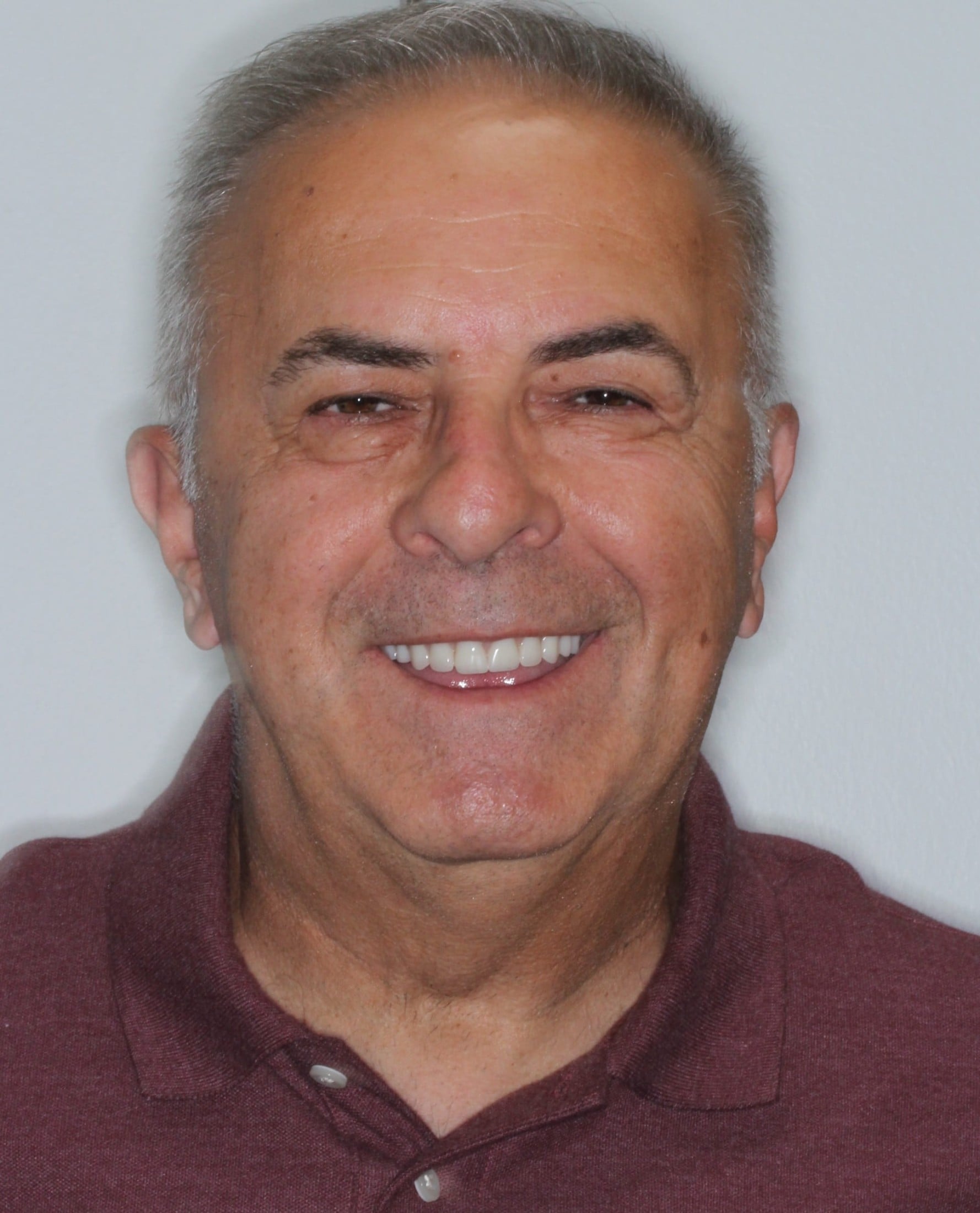 after dental implants