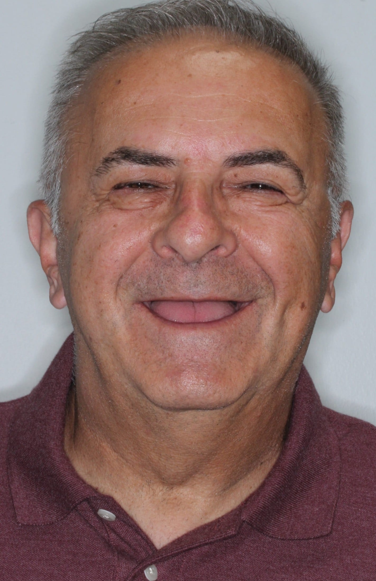 before dental implants